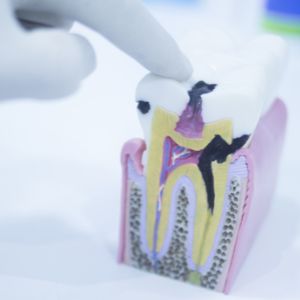Root Canal Therapy St. Clair West
